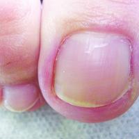 FOOTLOGIX 7T pret-sēnīšu tinktūra 50 ml